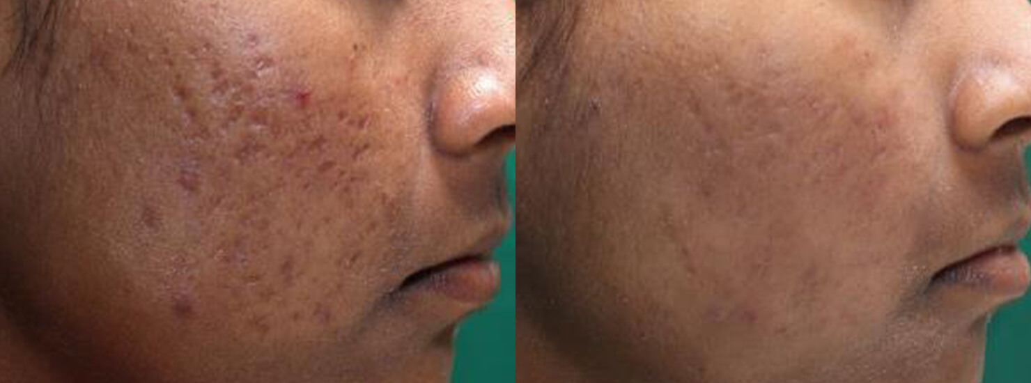 I Nixed My Acne Scars for Good with Fractional CO2 Laser