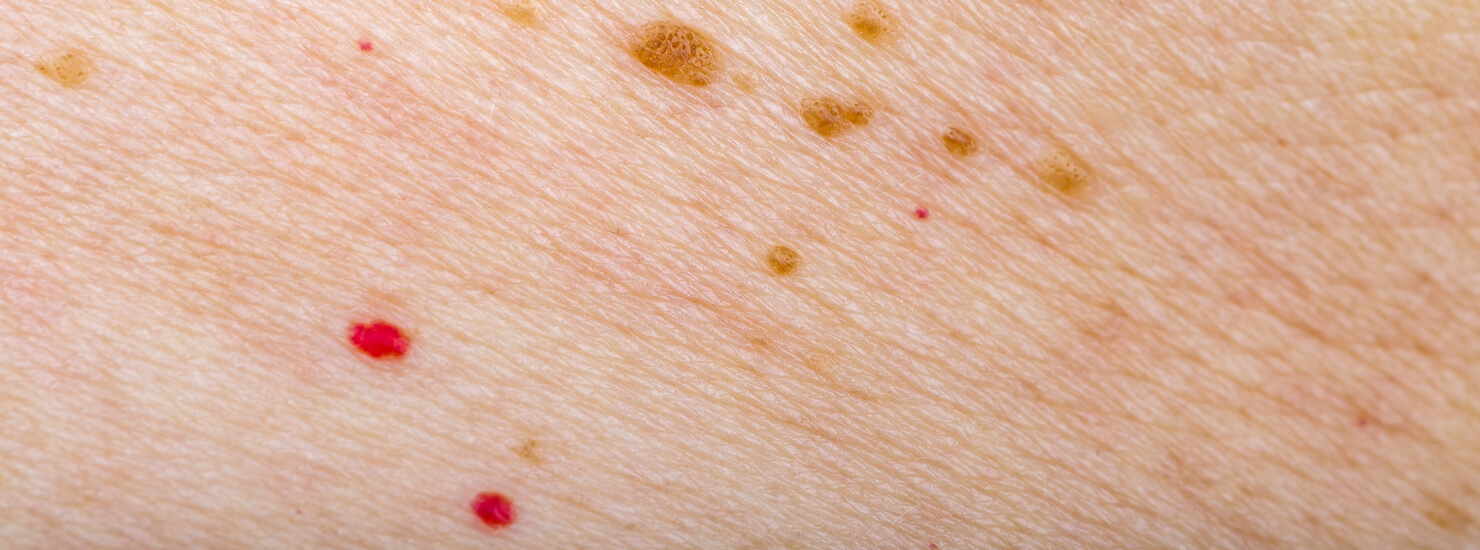 Blood Bumps On Skin